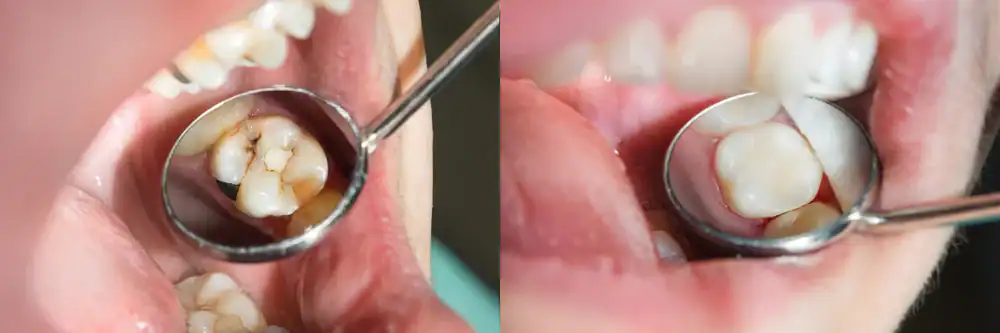 Close-up of a dentist’s mirror reflecting a molar with cavities or decay on the left, and a healthy, restored molar filling on the right. Both images feature open mouths, dental tools, and highlight expert dentist care.